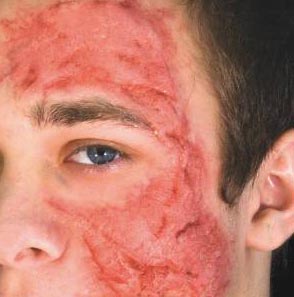 burn-scar-treatment