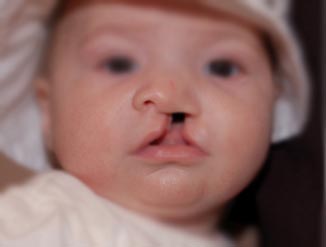 cleftlip-cleft-palate