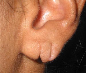 ear-lobe-tear