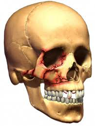 facial-bone-fracture