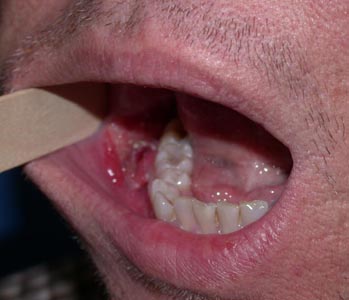 oral-cancer-surgery