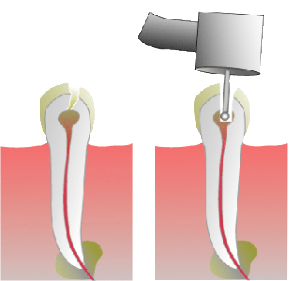 root-canal-treatment-Noida